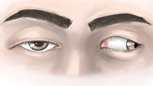 Liệt dây thần kinh số 3 là gì? Nguyên nhân và cách phòng ngừa hiệu quả