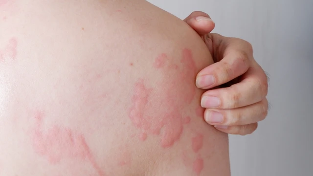 Mề đay: Dấu hiệu, nguyên nhân, phương pháp chẩn đoán, điều trị và phòng ngừa
