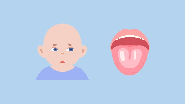 Nấm miệng là gì? Triệu chứng, cách điều trị và phòng ngừa lây nhiễm