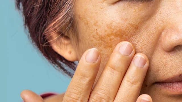 Nám nội tiết: Dấu hiệu, nguyên nhân, phương pháp chẩn đoán, điều trị và phòng ngừa
