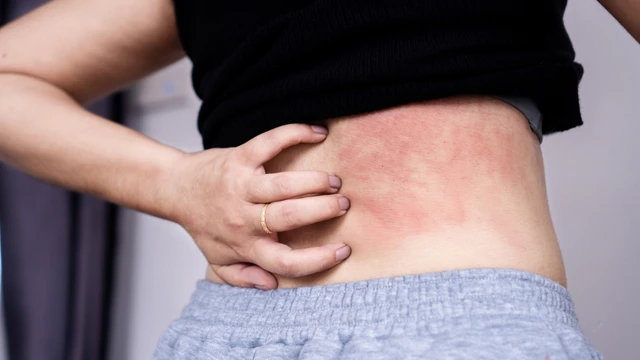 Phát ban keto: Dấu hiệu, nguyên nhân, phương pháp chẩn đoán, điều trị và phòng ngừa