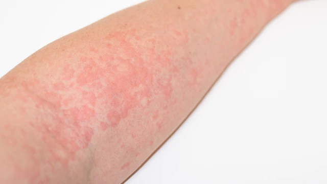 Sẩn ngứa là gì? Triệu chứng, nguyên nhân, cách điều trị và phòng ngừa