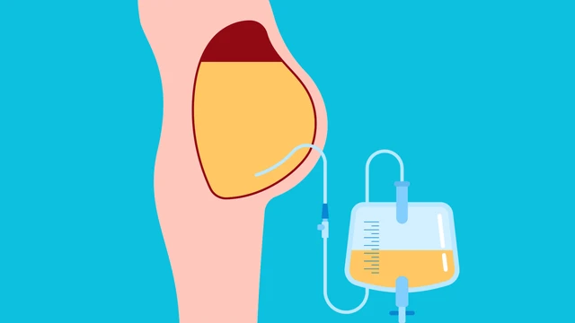 Tràn dịch màng bụng là gì? Nguyên nhân, triệu chứng và cách phòng ngừa