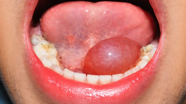 U nang dưới lưỡi là gì? Triệu chứng, nguyên nhân và cách điều trị