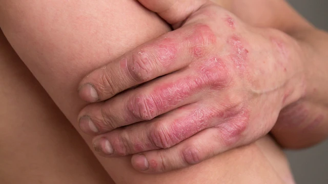 Bệnh vảy nến là gì? Triệu chứng, nguyên nhân, phương pháp chẩn đoán và điều trị hiệu quả