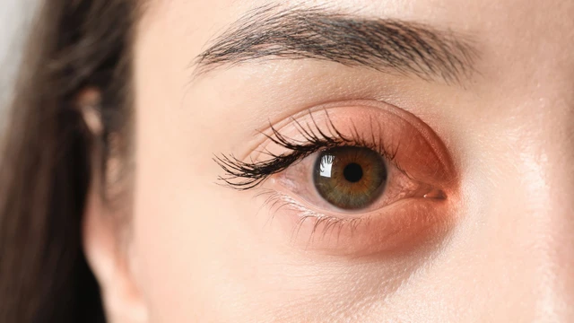 Viêm bờ mi: Nguyên nhân gây bệnh và phương pháp điều trị, phòng ngừa hiệu quả