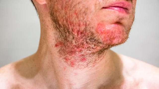 Viêm da tiết bã nhờn: Dấu hiệu, nguyên nhân, phương pháp chẩn đoán, điều trị và phòng ngừa