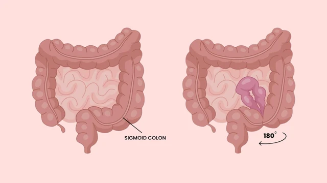 Xoắn đại tràng sigma là gì? Nguyên nhân và cách phòng ngừa hiệu quả