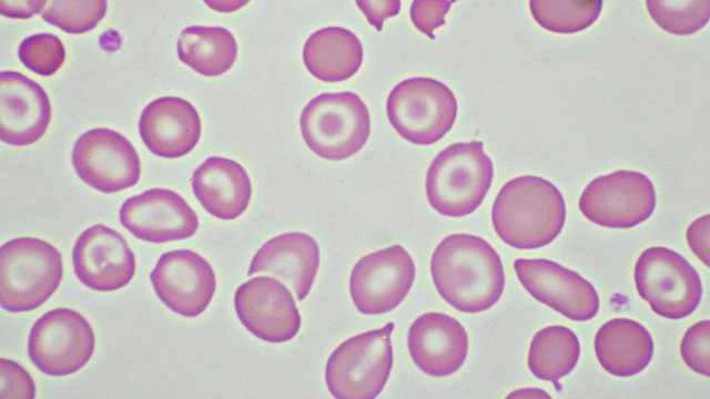 Bệnh Alpha Thalassemia là gì? Biến chứng và biện pháp phòng ngừa