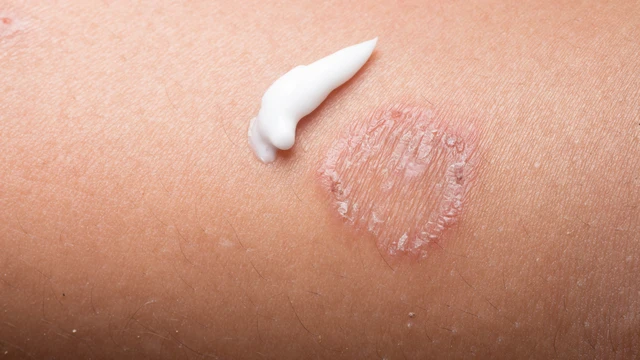Bệnh hắc lào​ là gì? Triệu chứng, nguyên nhân, chẩn đoán và phương pháp điều trị 