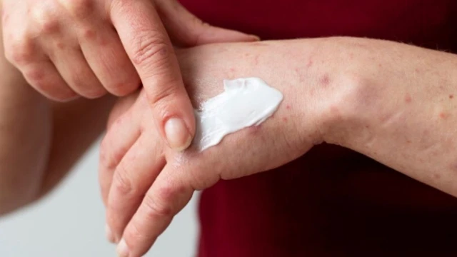 Bệnh hắc lào có tự khỏi không​? Nên điều trị như thế nào?