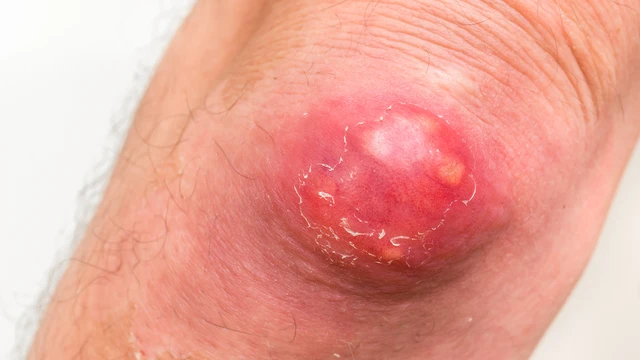 Bệnh hậu bối là gì? Triệu chứng, nguyên nhân, chẩn đoán và điều trị