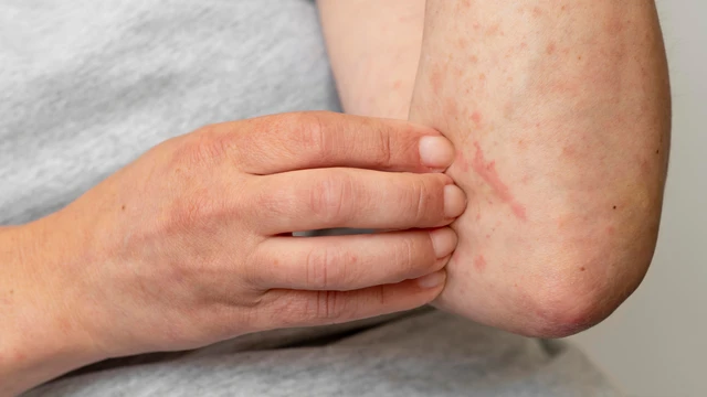 Bệnh sởi có nguy hiểm không? Biến chứng và cách phòng ngừa