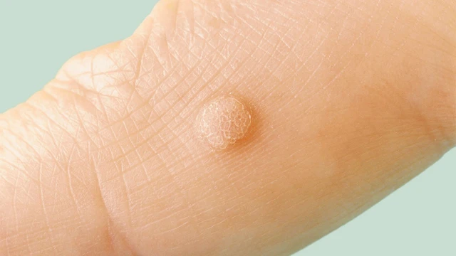 Bệnh sùi mào gà nhẹ biểu hiện như thế nào? Điều trị ra sao?