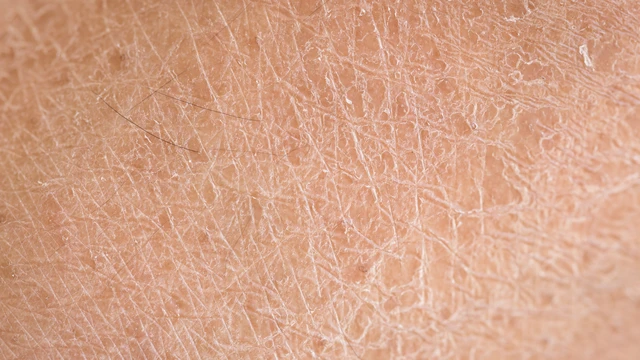 Bệnh vảy cá có lây không? Nguyên nhân và hướng chăm sóc phù hợp