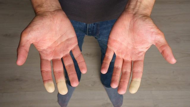 Bệnh xơ cứng bì sống được bao lâu? Tìm hiểu tiên lượng bệnh