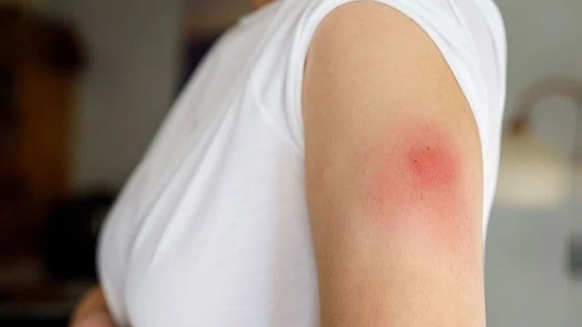 Bị áp xe vết tiêm: Nguyên nhân, dấu hiệu và cách điều trị