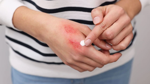 Bị bỏng nên ăn gì cho mau lành? Gợi ý thực phẩm giúp hỗ trợ phục hồi da