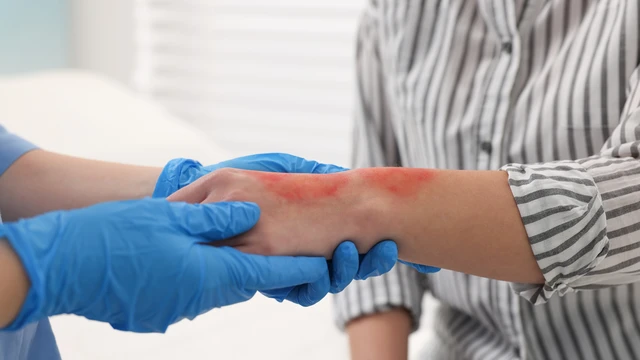 Bị bỏng nên làm gì? Hướng dẫn các bước sơ cứu đúng cách tại nhà