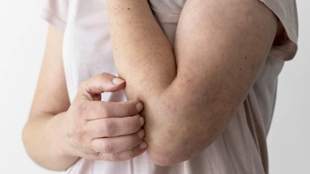 Bị ngứa khắp người: Nguyên nhân, triệu chứng và cách điều trị
