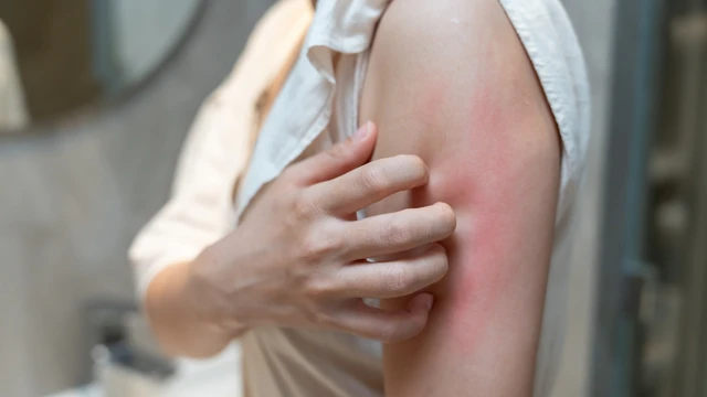 Bị nhiễm ký sinh trùng gây ngứa uống thuốc gì? Giải đáp từ góc độ y khoa