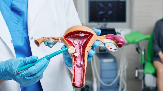 Bị u xơ tử cung có nên mổ không? Những trường hợp bắt buộc phải can thiệp