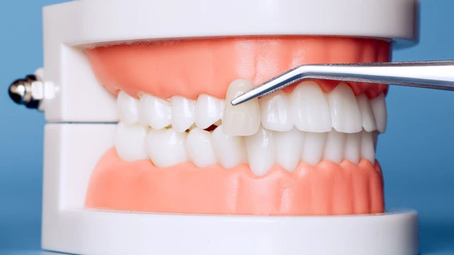 Bọc răng sứ có bị hôi miệng không và cách khắc phục