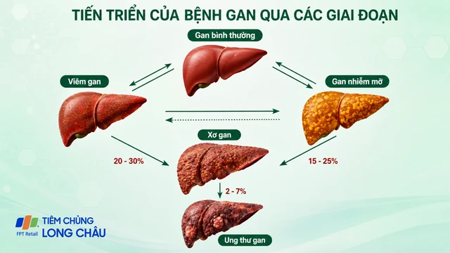 Các giai đoạn dẫn đến suy gan: Nhận biết sớm để bảo vệ gan