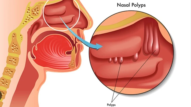 Cách chăm sóc sau mổ polyp mũi đúng cách để ngừa biến chứng