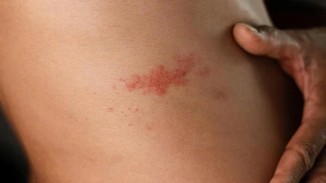 4 cách chữa giời leo không để lại sẹo an toàn và hiệu quả