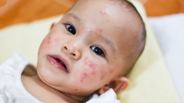 Cách làm sạch da cho trẻ bị viêm da cơ địa mà phụ huynh nên biết