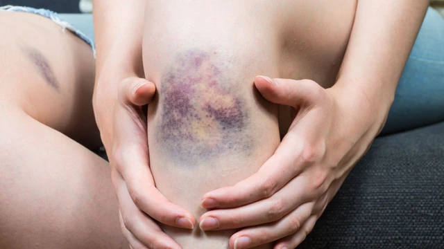 Cách làm tan máu bầm nhanh và an toàn tại nhà