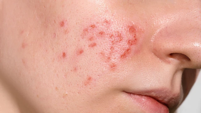 Cách làm xẹp mụn sưng đỏ sau 1 đêm: Hướng dẫn giảm viêm an toàn, dễ áp dụng