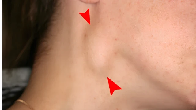 Cách nhận biết sưng hạch bạch huyết là gì? Phương pháp chẩn đoán và điều trị