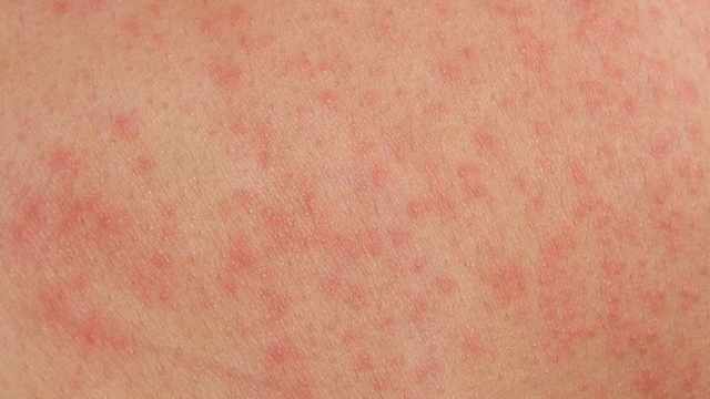 Cách phân biệt phát ban sốt xuất huyết và tử ban mô cầu