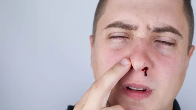 Cách sơ cứu chảy máu cam hiệu quả và các lưu ý quan trọng bạn cần biết