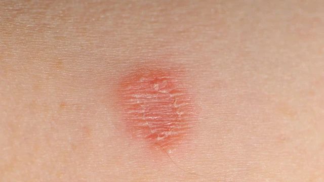Cách trị lác đồng tiền và những lưu ý khi điều trị