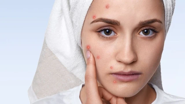 Cách trị mụn nội tiết​ hiệu quả và an toàn