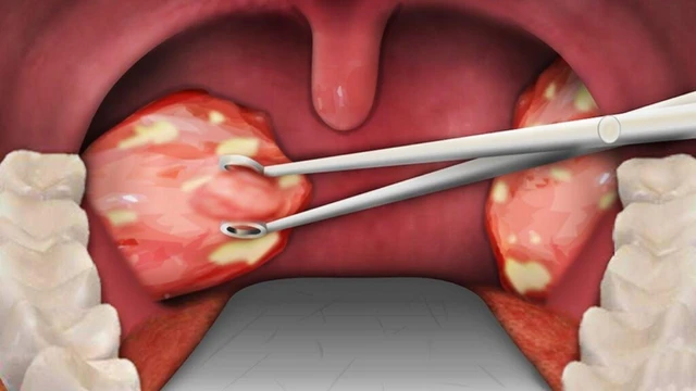 Cắt amidan bao lâu thì nói được? Cần lưu ý gì sau khi cắt amidan