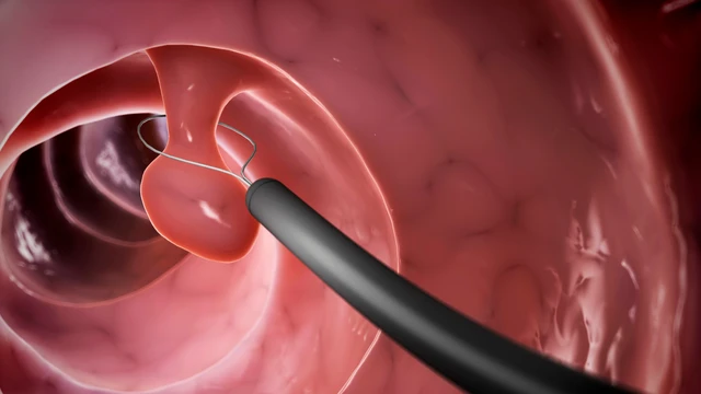 Cắt polyp mũi: Khi nào cần, quy trình và lưu ý quan trọng