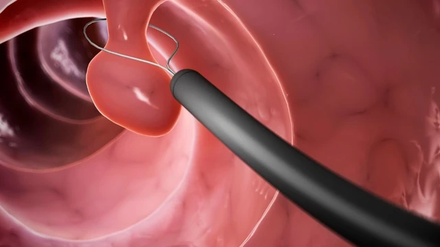 Cắt polyp trực tràng​: Quy trình thực hiện và cách vệ sinh sau khi cắt