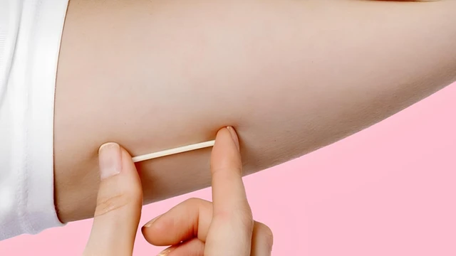 Cấy que tránh thai: Ưu điểm, nhược điểm và cách thực hiện