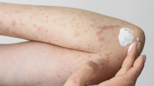 Chăm sóc da sau khi bị thủy đậu và những sai lầm cần tránh