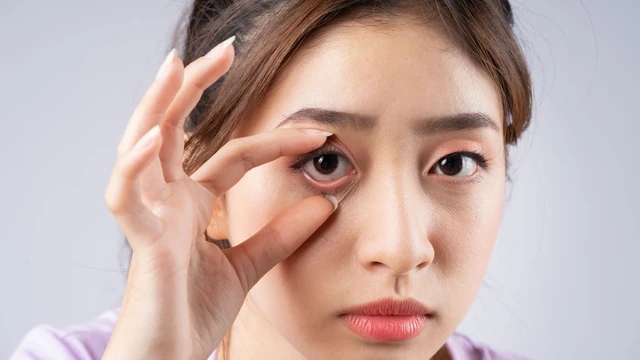 Chắp mắt bị vỡ có nguy hiểm không? Cách xử lý