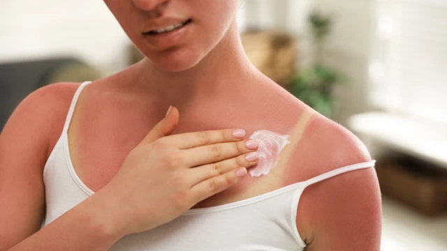 Cháy nắng bôi gì để da nhanh phục hồi?