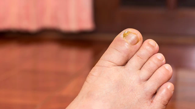 Chín mé ngón chân: Nguyên nhân, dấu hiệu và cách điều trị hiệu quả
