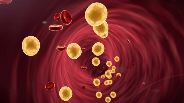 Cholesterol trong máu là gì? Nguyên nhân cholesterol trong máu cao