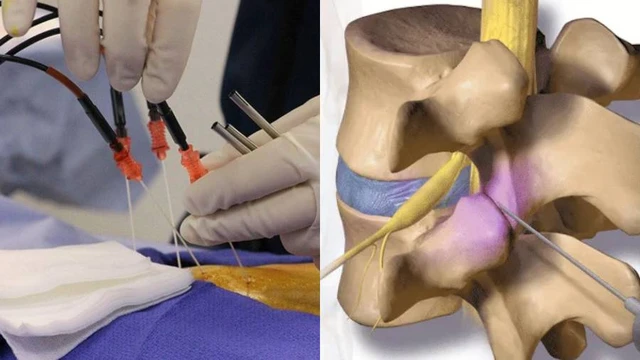 Chữa thoát vị đĩa đệm bằng sóng cao tần có tốt không?