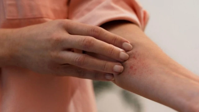 Ghẻ lở hắc lào​: Dấu hiệu và cách phân biệt 
