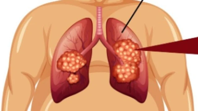 Xạ trị ung thư phổi bao nhiêu tiền?